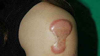 Cara Medis dan Alami Menghilangkan Keloid: Panduan Lengkap