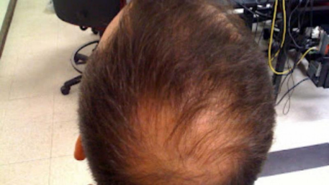 Rambut Rontok