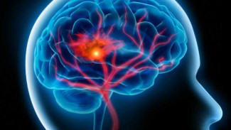 Dampak Fatal, Waspadai Gejala Stroke Sebelum Terlambat