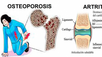 Lima Faktor Utama Penyebab Osteoporosis