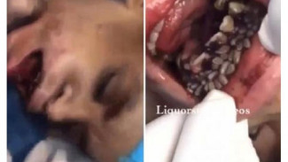 Mengerikan, Mulut Wanita Ini Penuh dengan Belatung