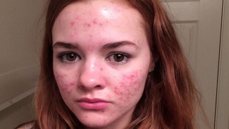 Pede Unggah Foto Wajah Penuh Jerawat, Wanita Ini Viral