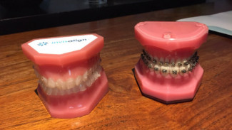 Clear Aligner, Metode Baru Rapikan Gigi
