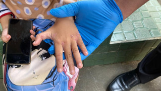 Penyakit Kulit Scabies Bisa Menular, Penyebabnya Menyeramkan