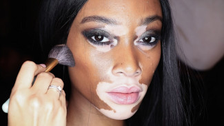 Bukan Penyakit Menular! Stres Berat Ternyata Bisa Mempercepat Penyebaran Vitiligo