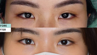 Mengenal Double Eyelid, Salah Satu Standar Kecantikan Wanita Korea