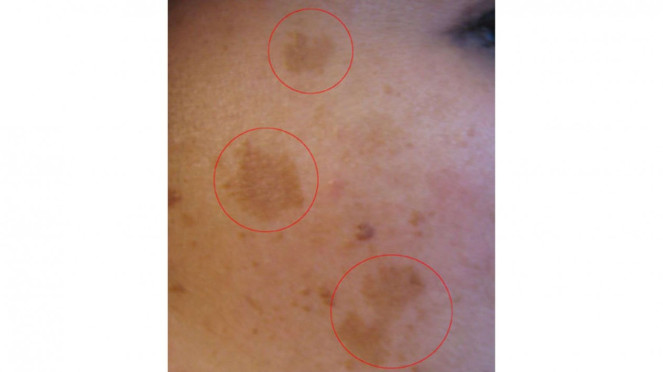 melasma