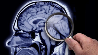 Ilmuwan Optimis Akan Segera Temukan Obat Untuk Mengobati Alzheimer