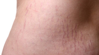 Tips Jitu dari Dokter! Ini Cara Aman & Efektif Pudarkan Stretch Mark Tanpa Efek Samping!