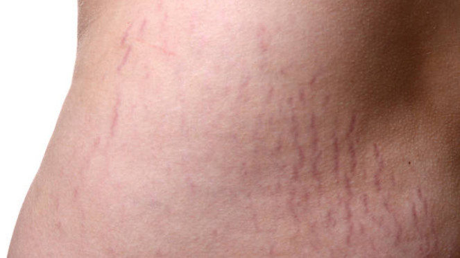 Stretch Mark